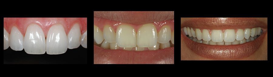 Natural dental results with cosmetic dentistry
