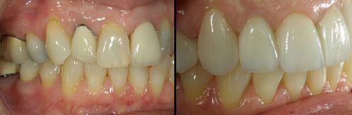 Dental Crowns Before & After in Columbia SC
