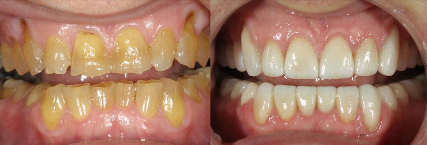 Restorative dentistry before and after in Columbia South Carolina