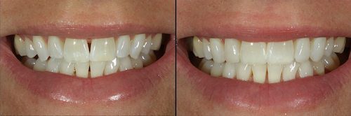 Before & After Photo Tooth Bonding By Columbia SC Dentist