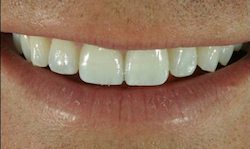 After teeth whitening by Columbia SC Dentist