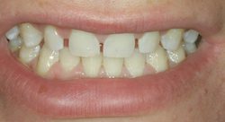 Porcelain Veneers Before