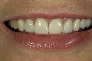 After Dental Bridge Treatment By Columbia SC Dentist