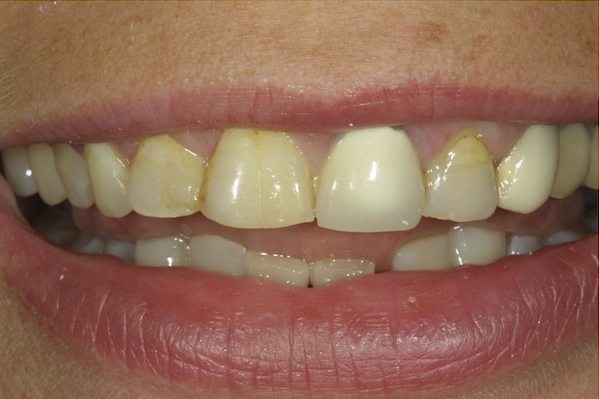 Before Dental Bridge By Columbia SC Dentist