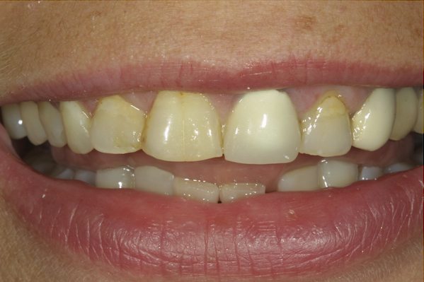 Composite Tooth Bonding Columbia SC