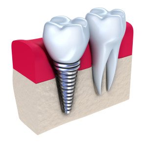 Dental implants can reduce bone loss after losing a tooth