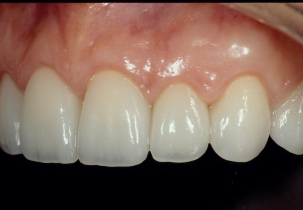 Natural Dental Result
