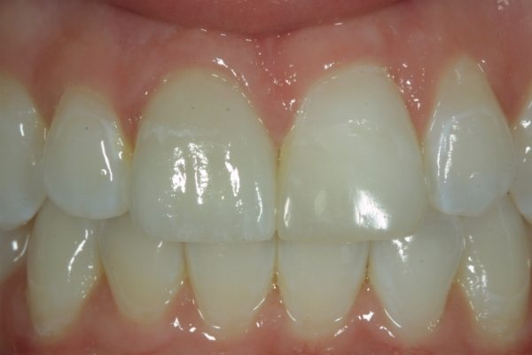 Natural Dental Result