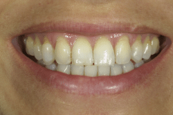Dental patient Gisselle at Dr Tom Trinkner