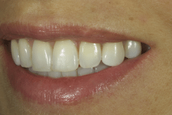 Dental patient Gisselle at Dr Tom Trinkner