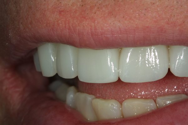 Natural Dental Result