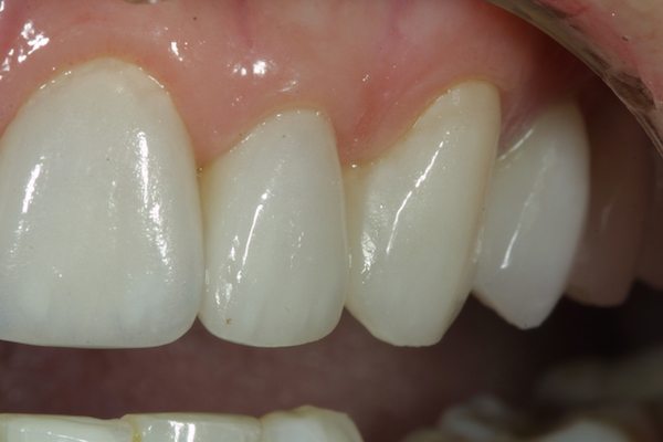 Natural Dental Result