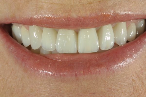 Natural Dental Result