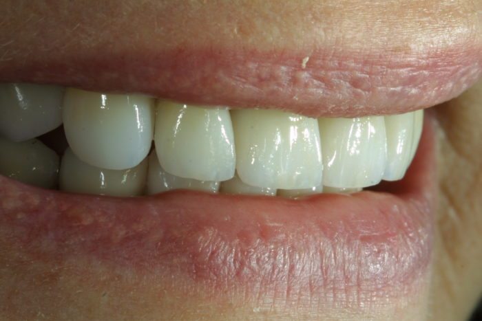 Natural Dental Result