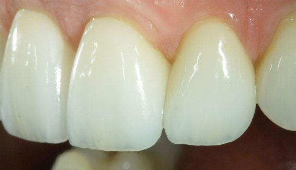 Natural Dental Result