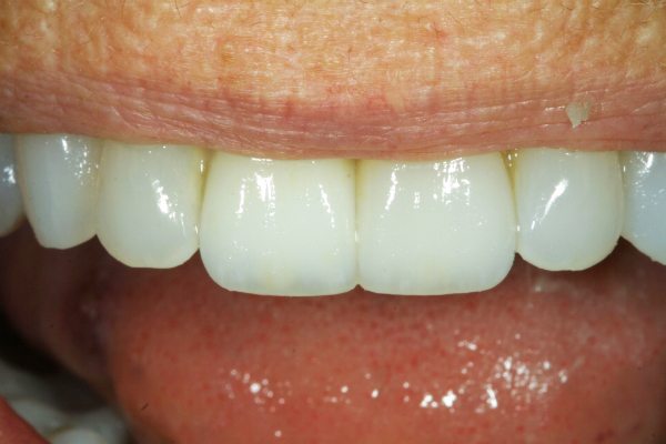 Natural Dental Result