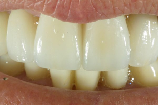 Natural Dental Result