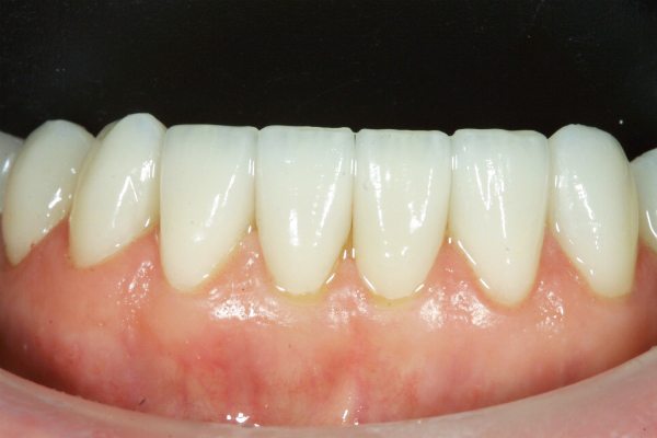 Natural Dental Result
