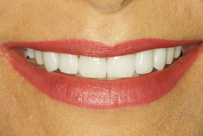 Natural Dental Result