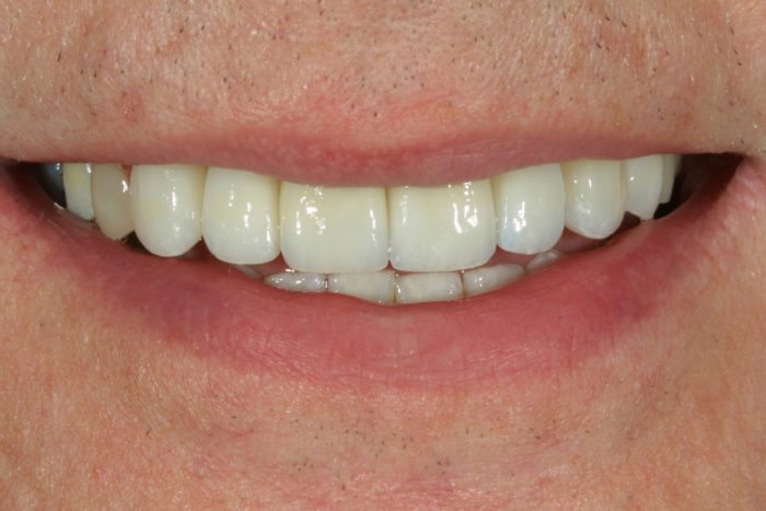 Natural Dental Result