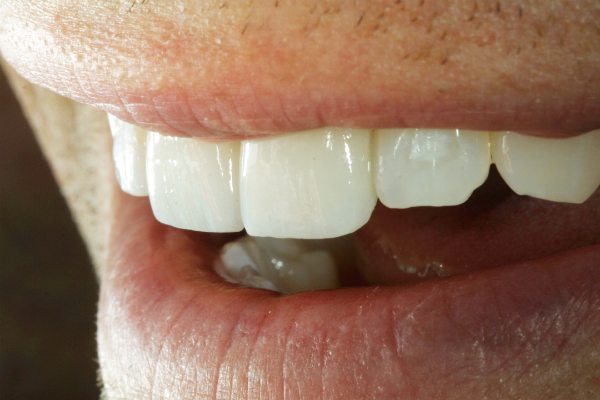 Natural Dental Result