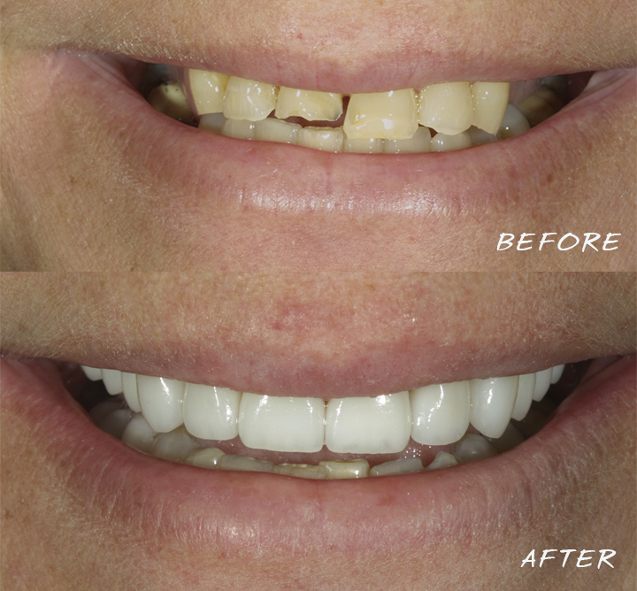 What to Do for a Chipped Tooth | Dr. Tom Trinkner | Columbia