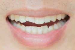 Damaged Teeth Solutions Columbia SC