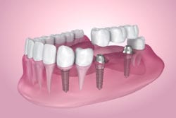 implant bridge columbia sc