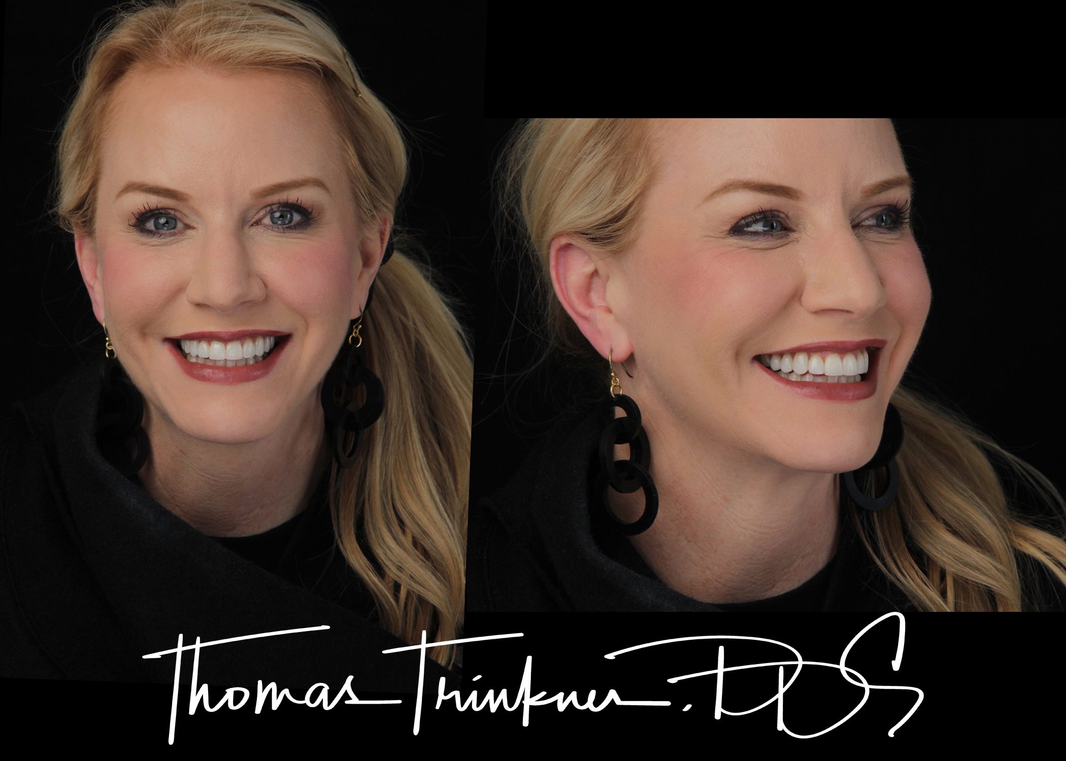 Dental Patient after getting porcelain veneers in Columbia, SC, at Dr. Trinkner's office