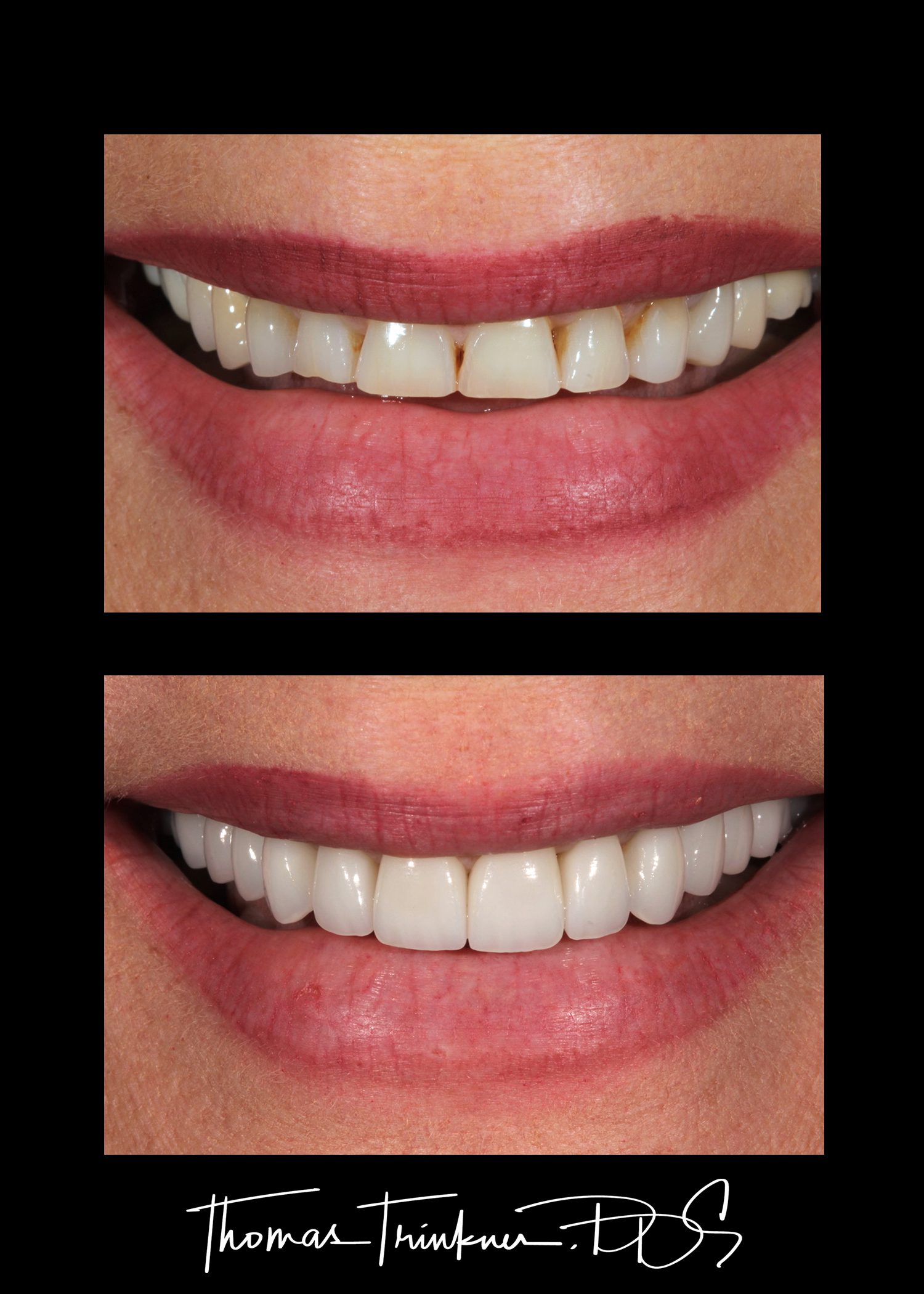 Before and after Porcelain Veneers case in Columbia SC