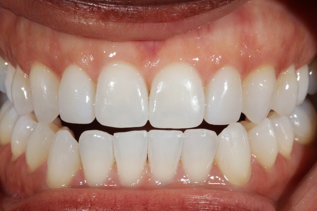 After getting porcelain veneers