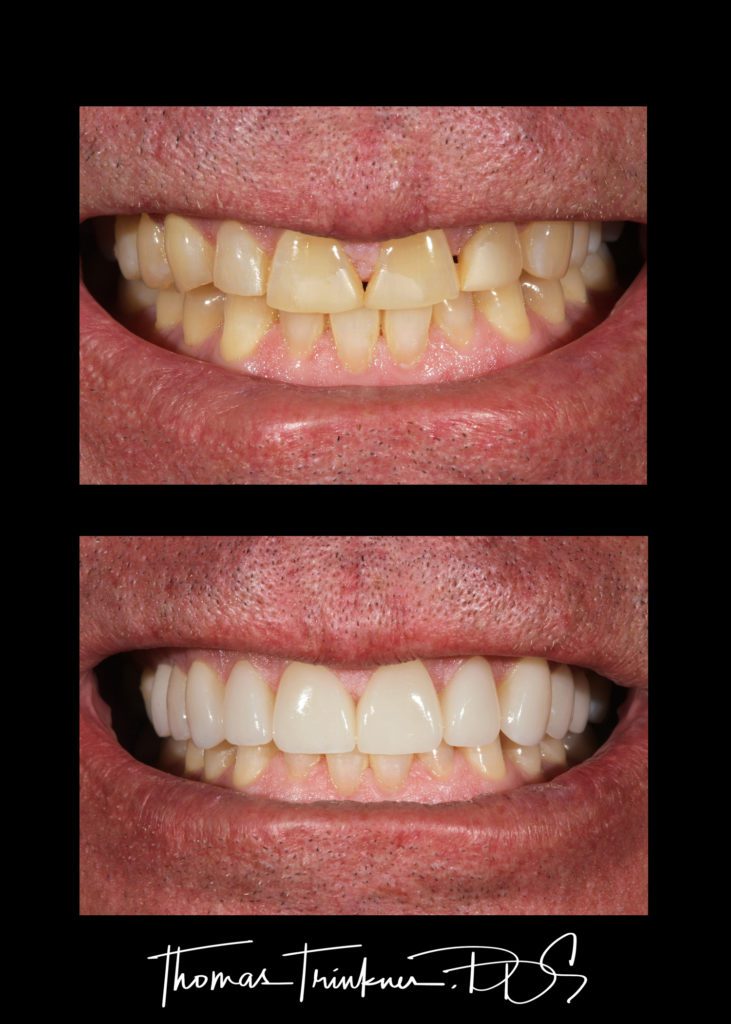 Dental Patient before and after worn teeth treatment