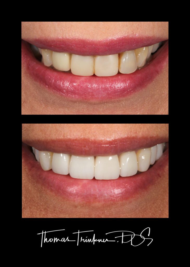 Before and after teeth whitening in Columbia SC