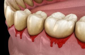 3D image of bleeding gums periodontal disease gum disease dentist in Columbia South Carolina
