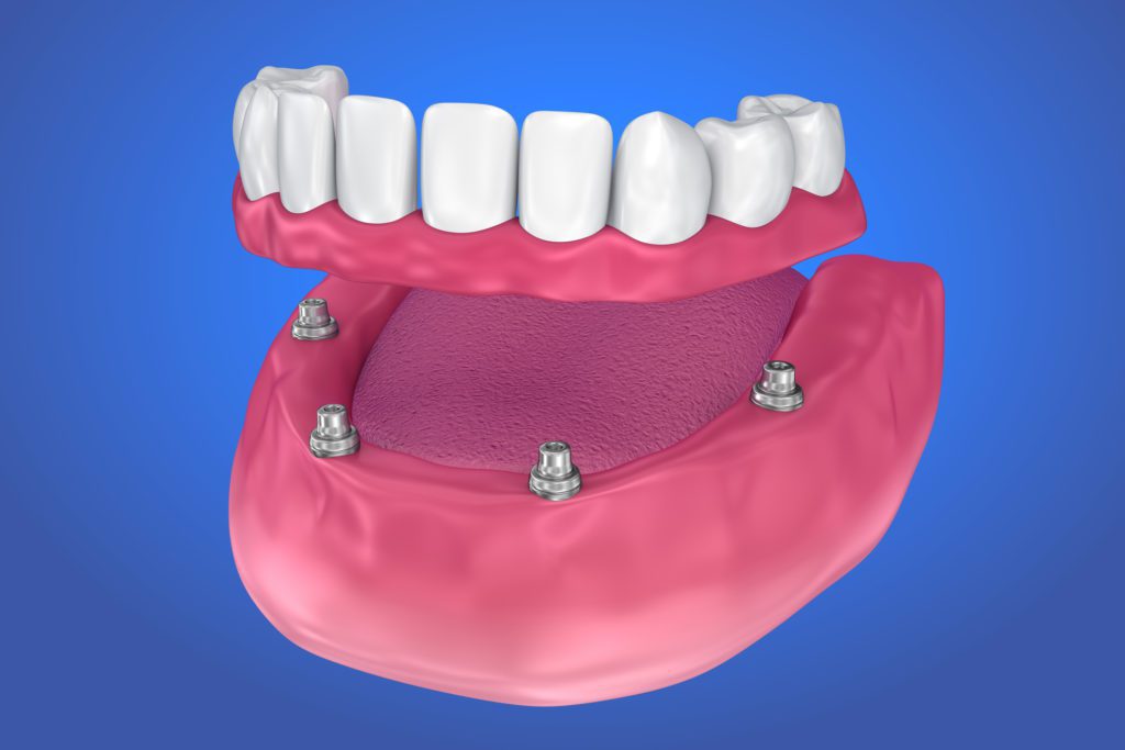 Dental Implants vs Dentures in Columbia, SC