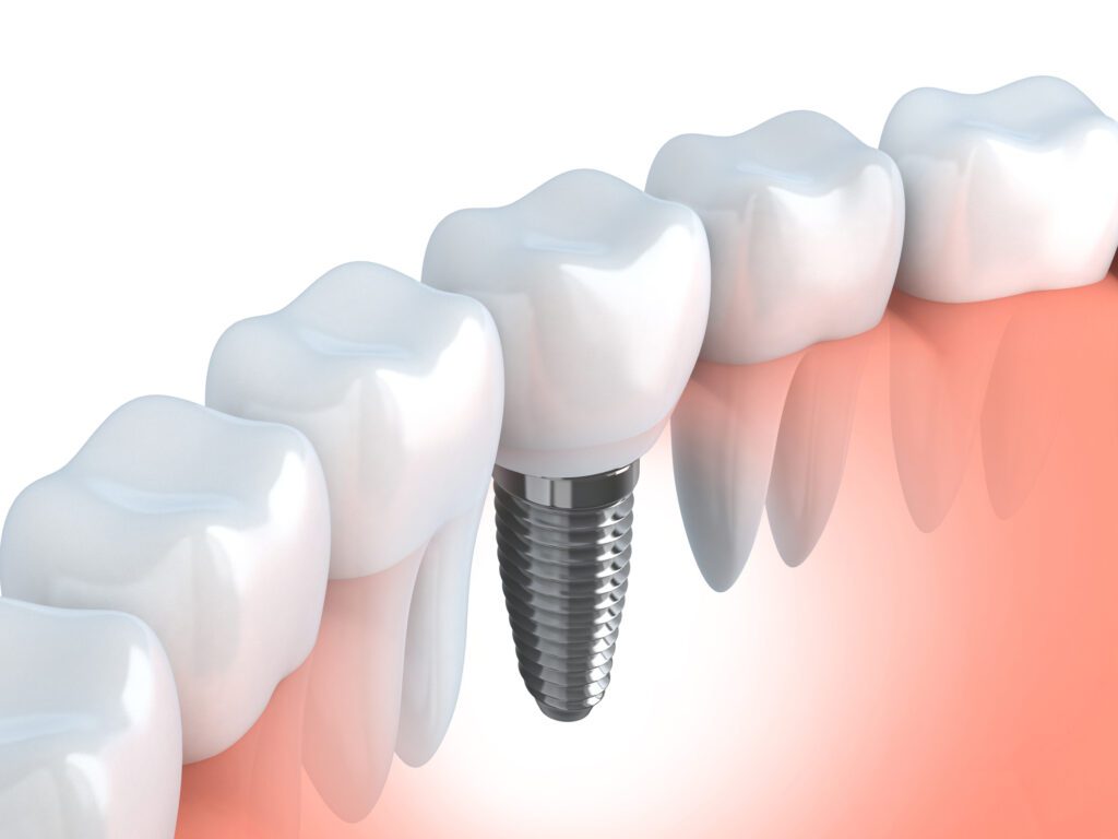 Implant Supported Crown in Columbia SC