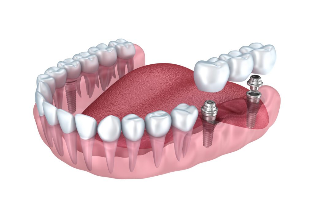 Implant-supported dental bridge in Columbia, SC