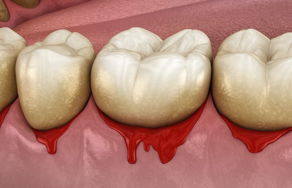 Are Your Gums Healthy?