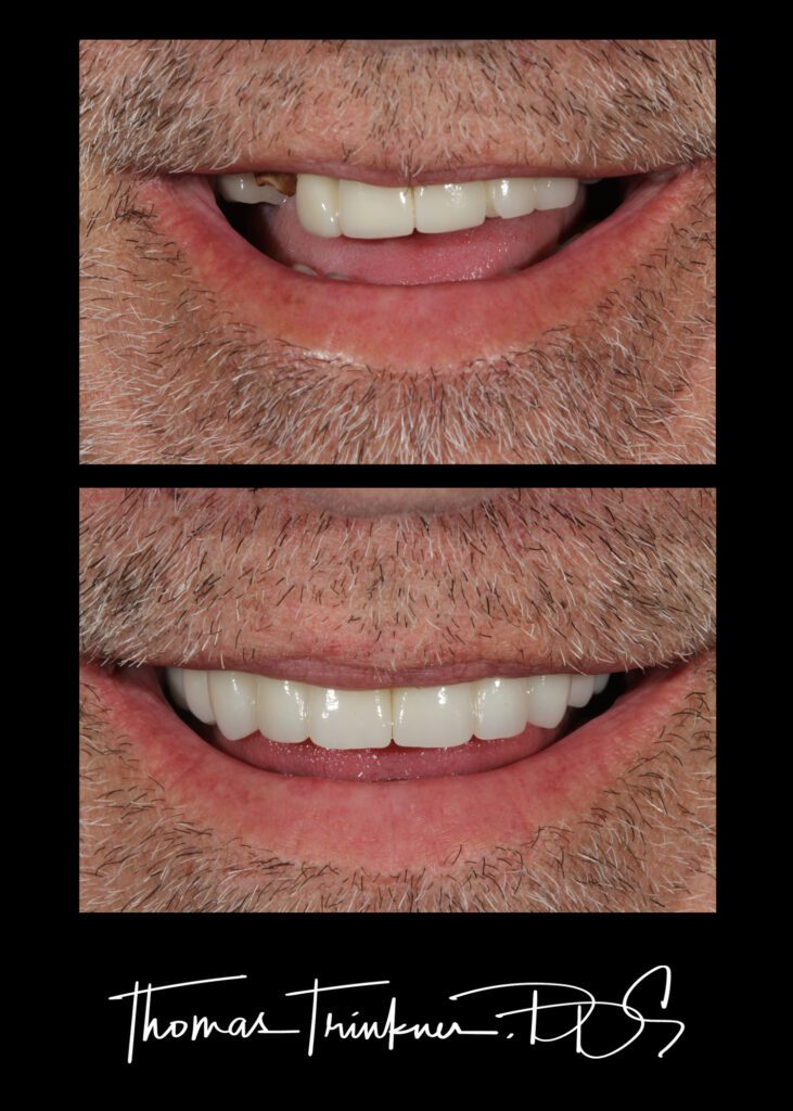 Patient before and after dental implants in Columbia SC