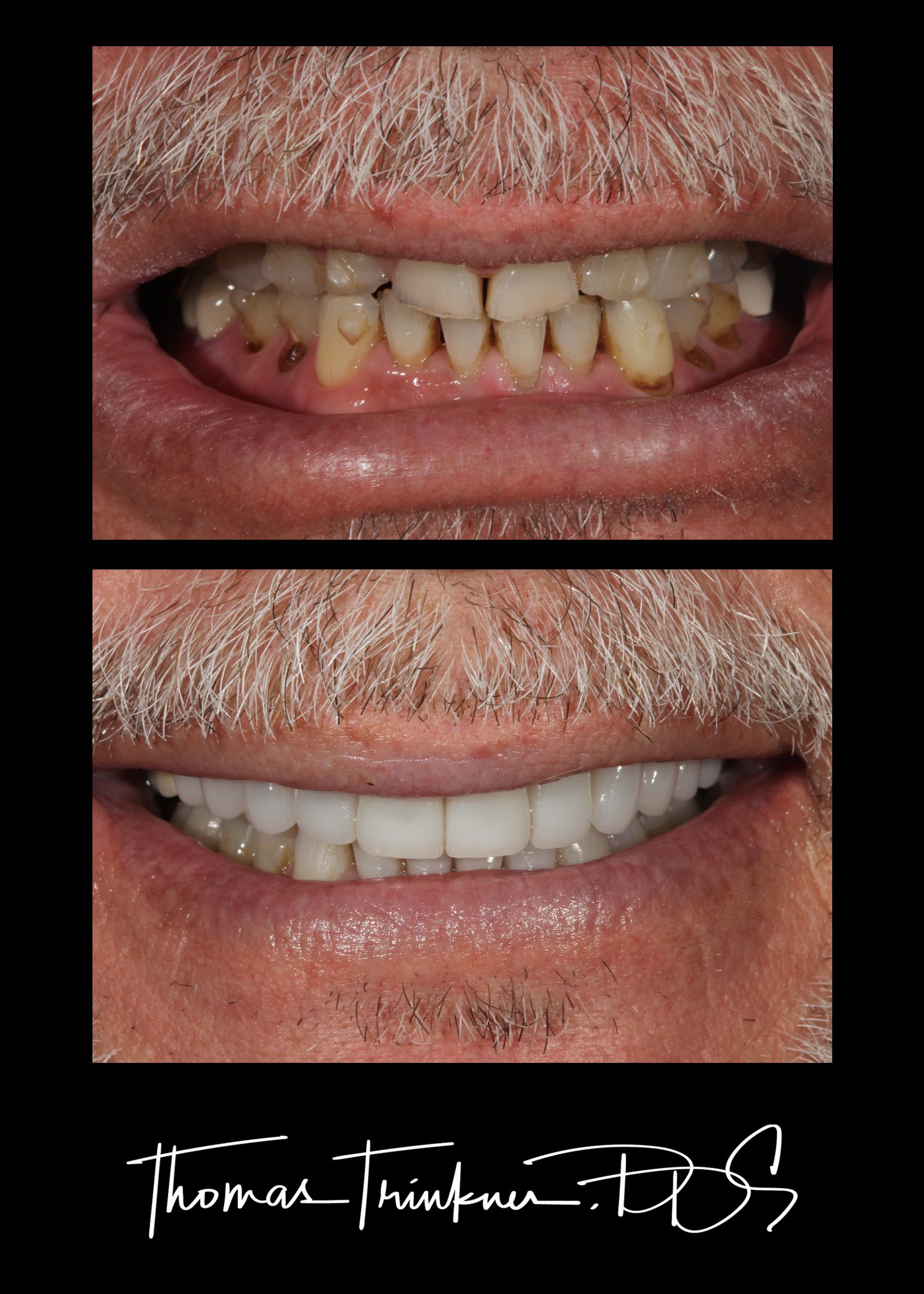 Dental implants after gum treatments
