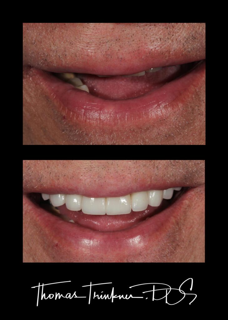 Before and after implant-supported bridge