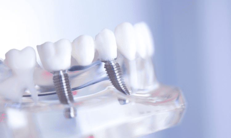 With advancements in dental technology, dental implants have become one of the most popular options for restoring missing teeth.