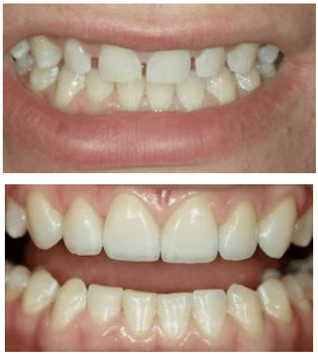 Before and after porcelain veneers procedure at Dr. Thomas Trinkner in Columbia, SC