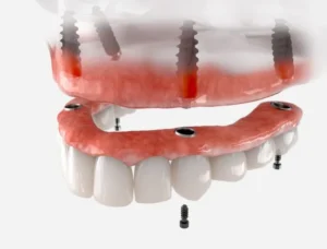 Implant-Secured Dentures: Stop the Slipping in Columbia, SC