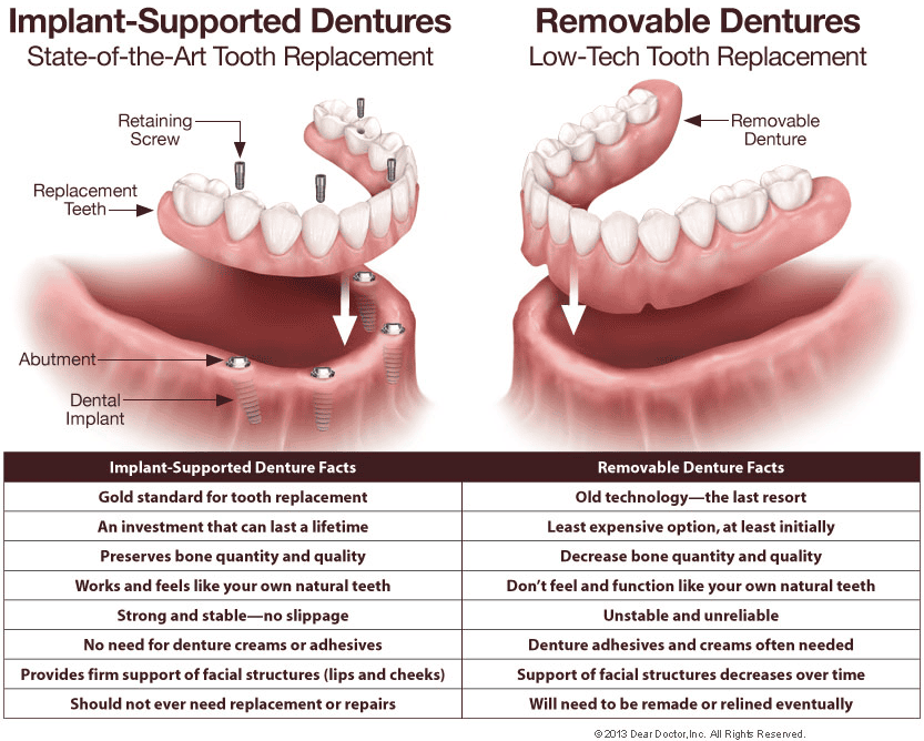 Dental Implants vs. Dentures: Pros and Cons for Columbia Patients